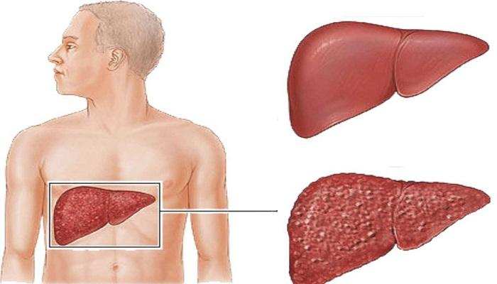 الالتهاب الكبدي الوبائي B